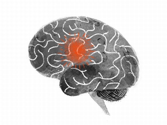 dấu hiệu thường gặp của đột quỵ1